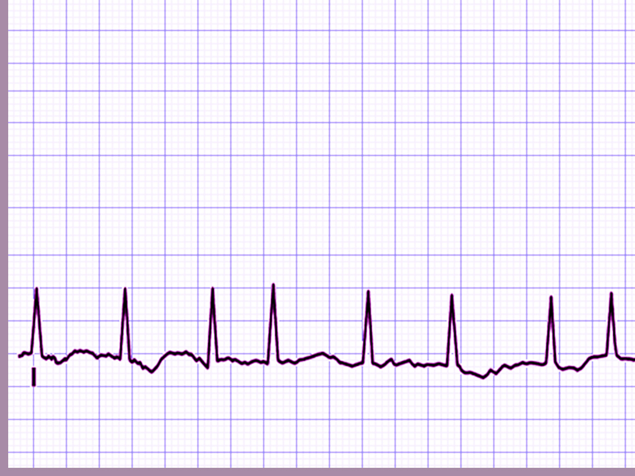Cardiology Rhythm PPT templates